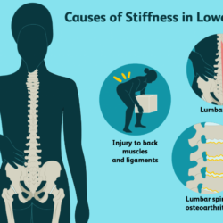 How can stiff and tight muscles result in back pain?